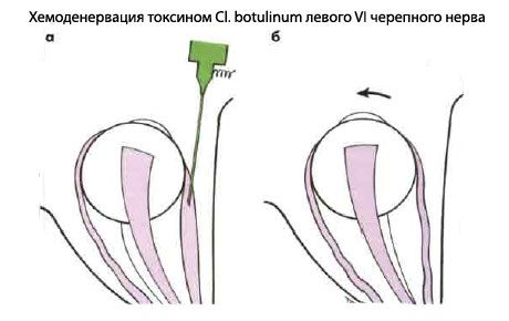 Strabismus - Operacja