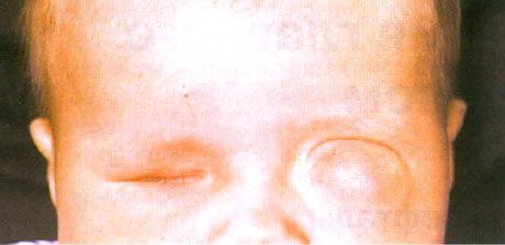 Mikroftalmos z towarzyszącym tworzeniem się torbieli (oko lewe). Anoftalmos (oko prawe).