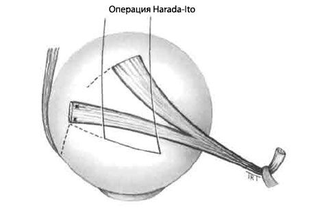 Strabismus - Operacja