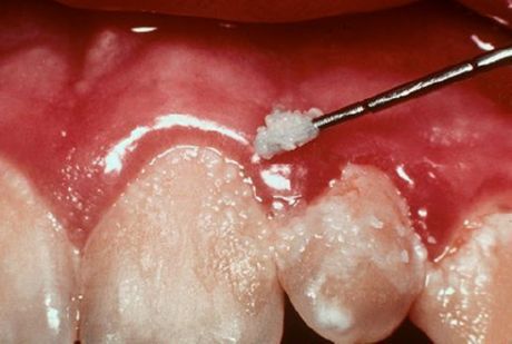Zęby i zapalenie dziąseł