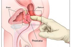masaż prostaty nie ma erekcji